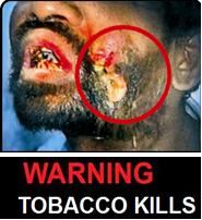 India 2013 Health Effects Mouth (Smokeless Tobacco Products) - diseased organ, gross 2